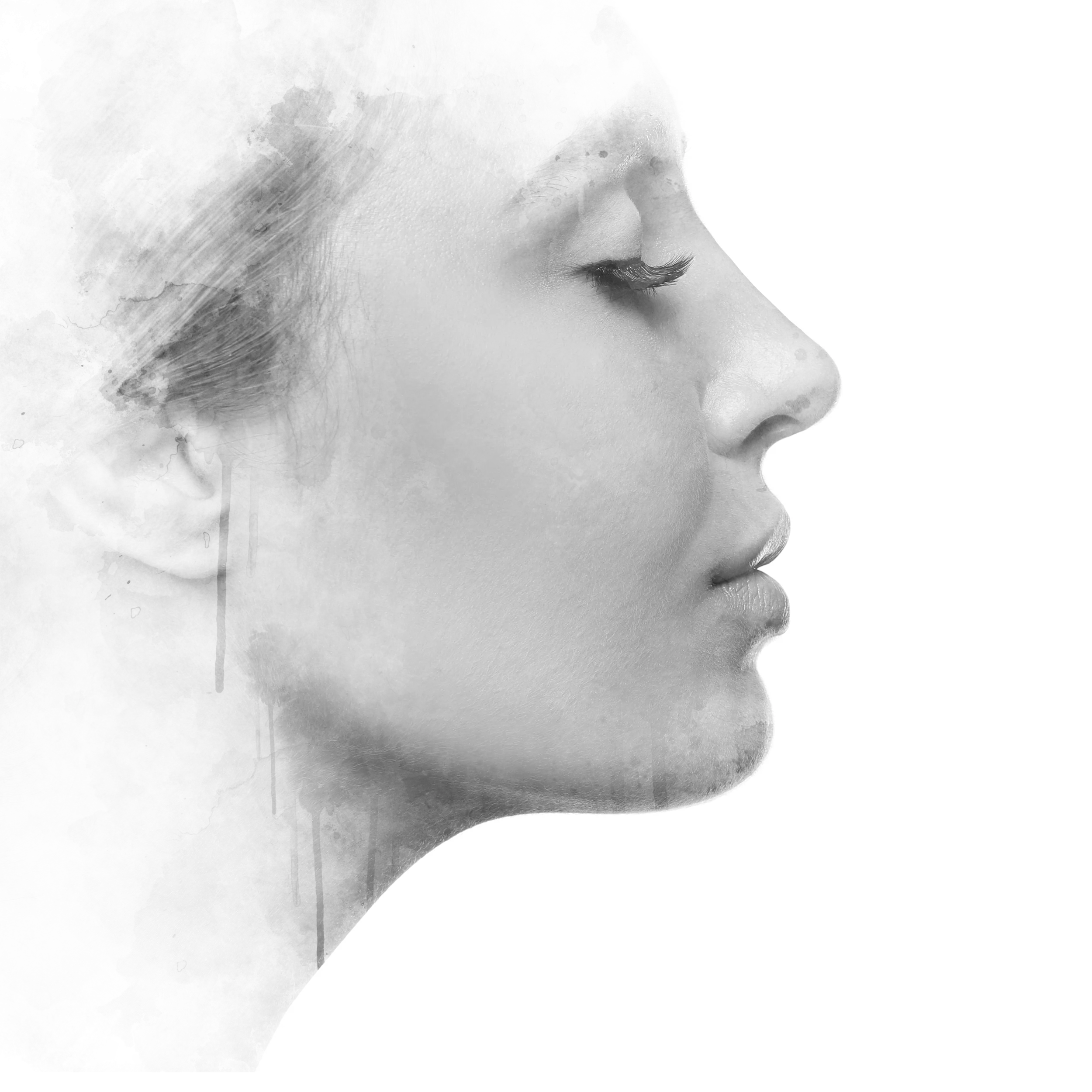 Rhinoplasty